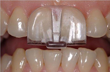 Taiko buik Ijver Pak om te zetten NTI-TSS splint helpt tegen tandenknarsen, bestel hier online